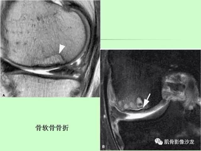 【PPT】骨骼肌肉系统疾病MRI诊断基础
