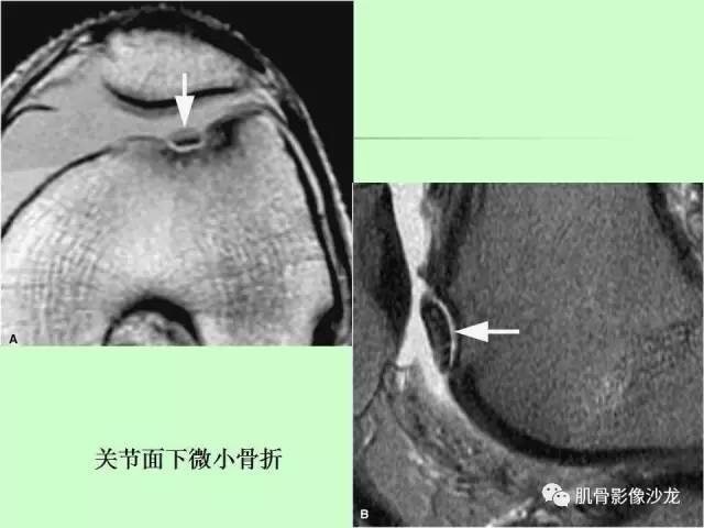 【PPT】骨骼肌肉系统疾病MRI诊断基础