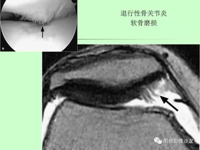 【PPT】骨骼肌肉系统疾病MRI诊断基础