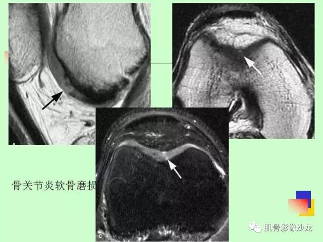 【PPT】骨骼肌肉系统疾病MRI诊断基础