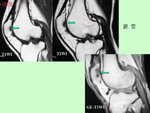 【PPT】骨骼肌肉系统疾病MRI诊断基础