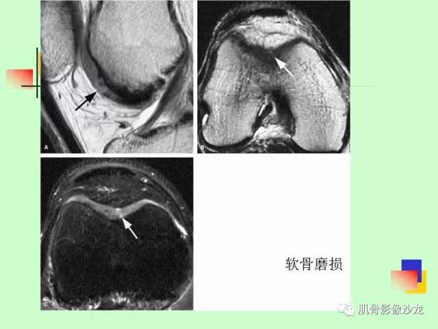 【PPT】骨骼肌肉系统疾病MRI诊断基础