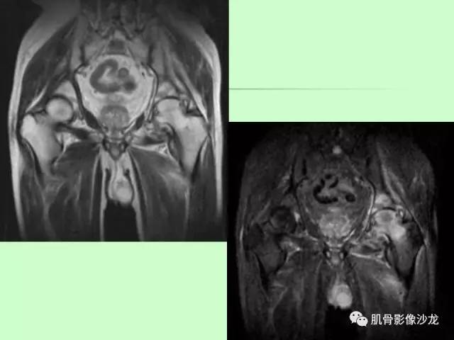 【PPT】骨骼肌肉系统疾病MRI诊断基础