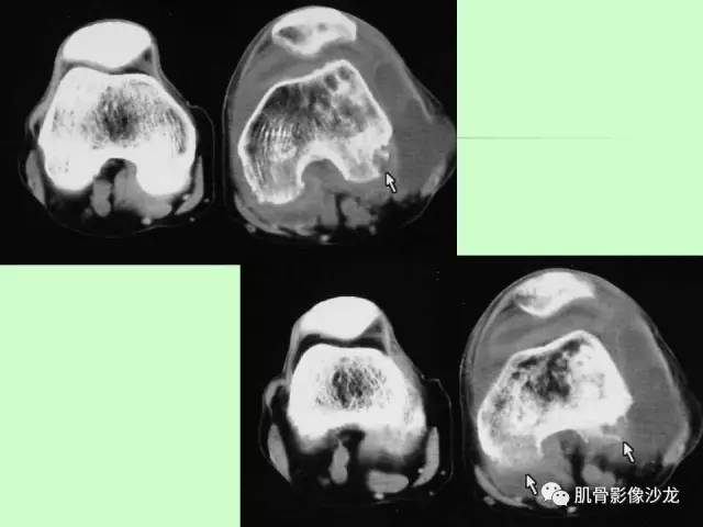 【PPT】骨骼肌肉系统疾病MRI诊断基础