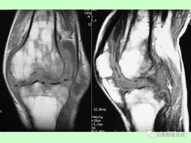 【PPT】骨骼肌肉系统疾病MRI诊断基础