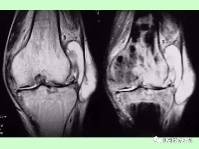 【PPT】骨骼肌肉系统疾病MRI诊断基础