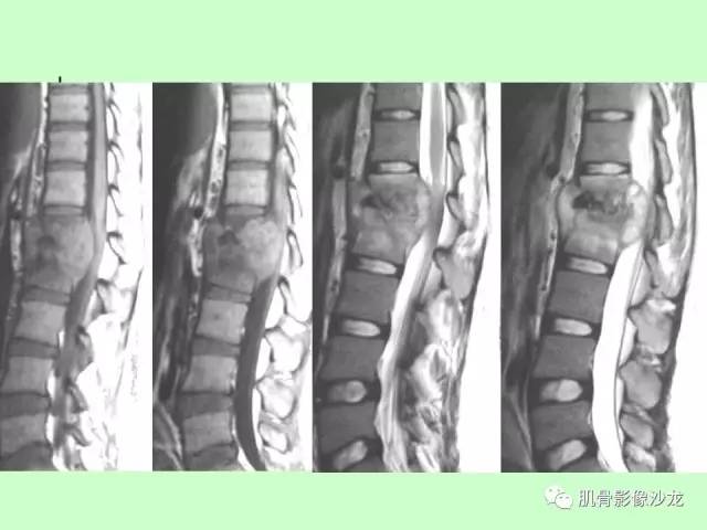 【PPT】骨骼肌肉系统疾病MRI诊断基础