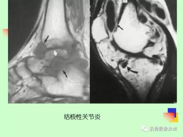 【PPT】骨骼肌肉系统疾病MRI诊断基础