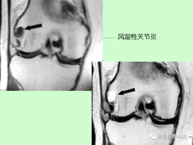 【PPT】骨骼肌肉系统疾病MRI诊断基础