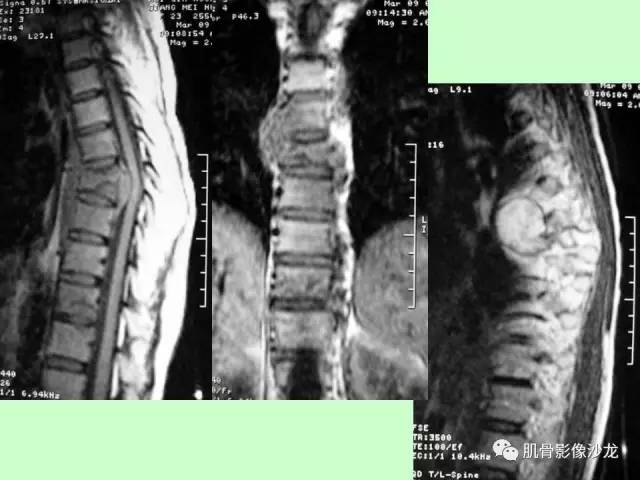【PPT】骨骼肌肉系统疾病MRI诊断基础