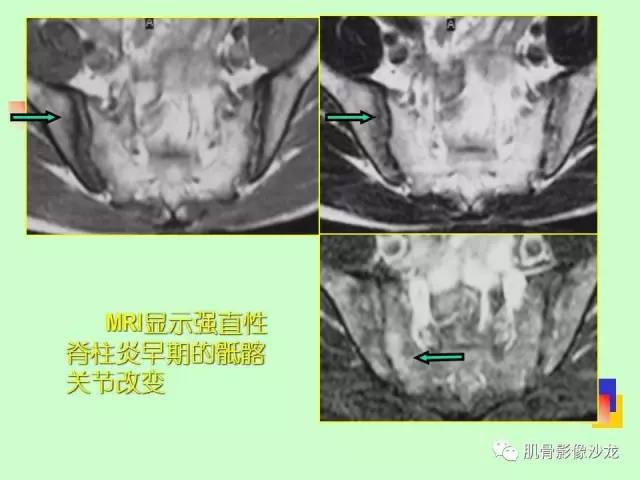 【PPT】骨骼肌肉系统疾病MRI诊断基础