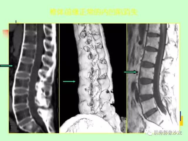【PPT】骨骼肌肉系统疾病MRI诊断基础
