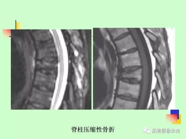 【PPT】骨骼肌肉系统疾病MRI诊断基础