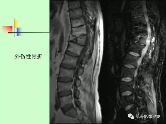 【PPT】骨骼肌肉系统疾病MRI诊断基础