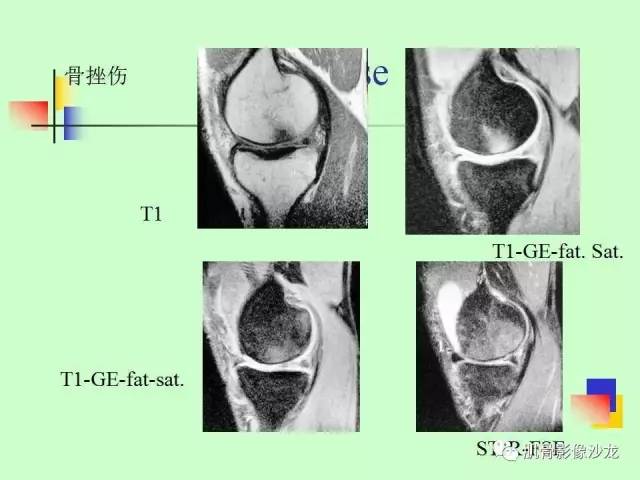【PPT】骨骼肌肉系统疾病MRI诊断基础