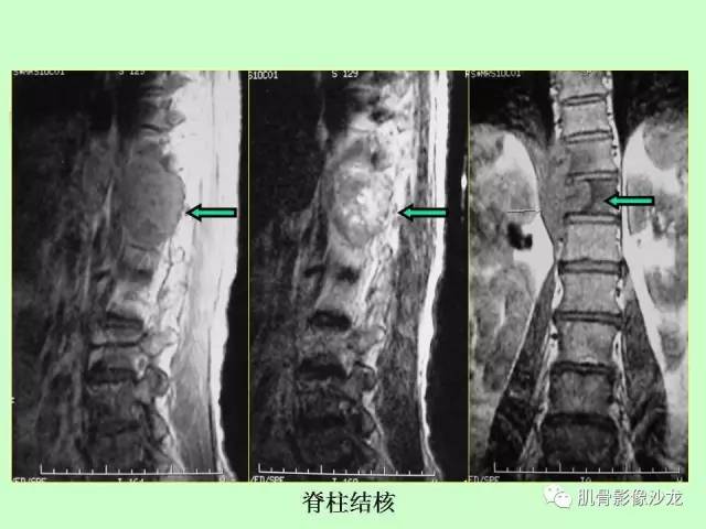 【PPT】骨骼肌肉系统疾病MRI诊断基础
