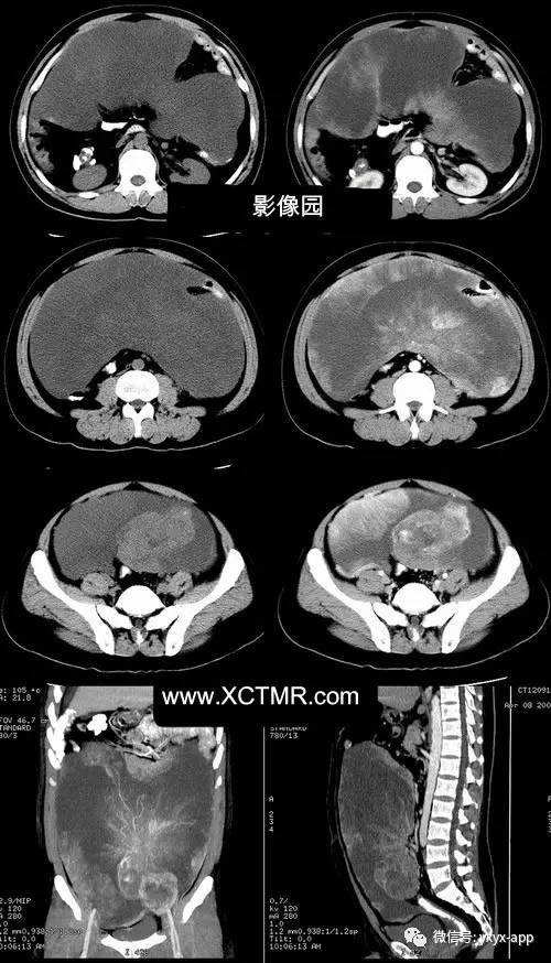 【病例】腹腔巨大恶性间质瘤1里CT影像表现