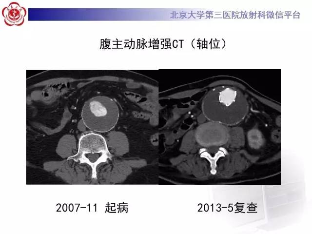 【病例】主动脉腔内修复术后并发症——内漏1例CT