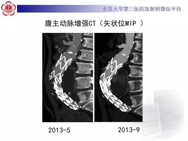 【病例】主动脉腔内修复术后并发症——内漏1例CT