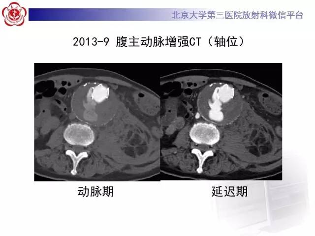 【病例】主动脉腔内修复术后并发症——内漏1例CT