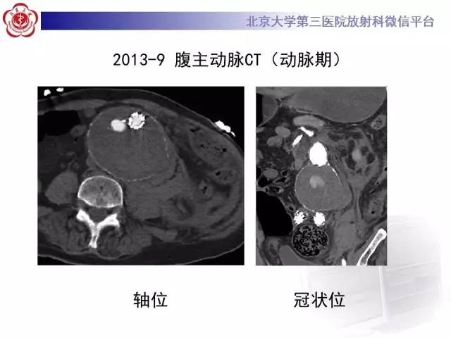 【病例】主动脉腔内修复术后并发症——内漏1例CT