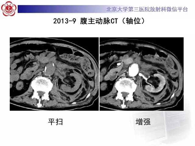 【病例】主动脉腔内修复术后并发症——内漏1例CT