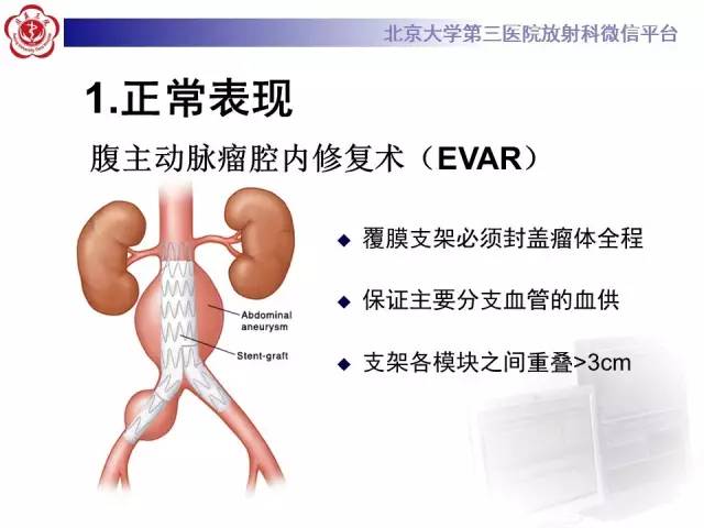【病例】主动脉腔内修复术后并发症——内漏1例CT