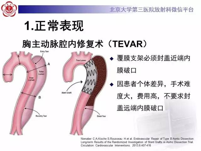 【病例】主动脉腔内修复术后并发症——内漏1例CT