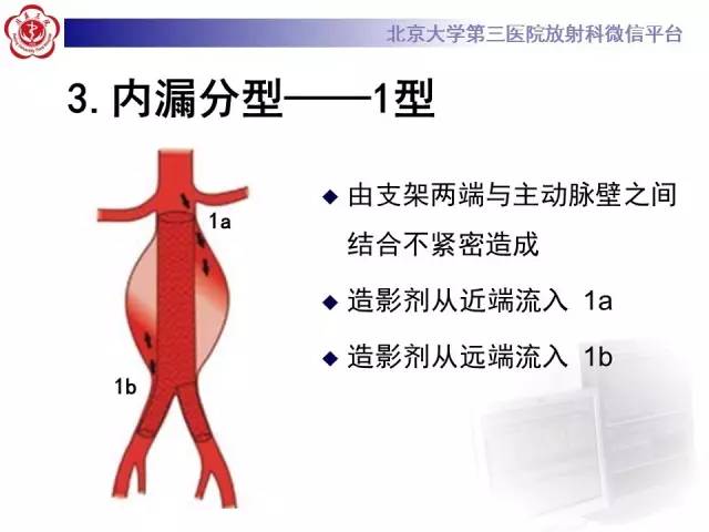 【病例】主动脉腔内修复术后并发症——内漏1例CT