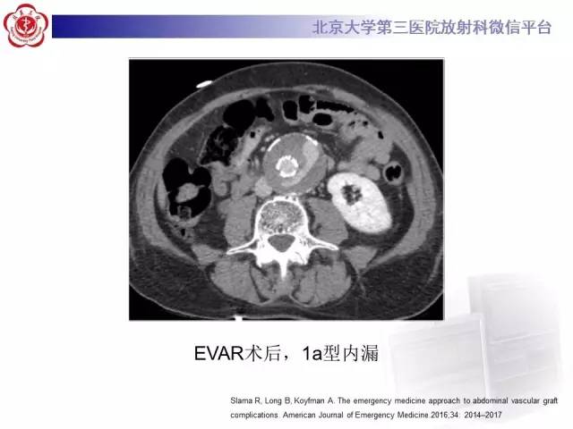 【病例】主动脉腔内修复术后并发症——内漏1例CT
