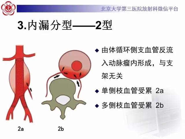 【病例】主动脉腔内修复术后并发症——内漏1例CT