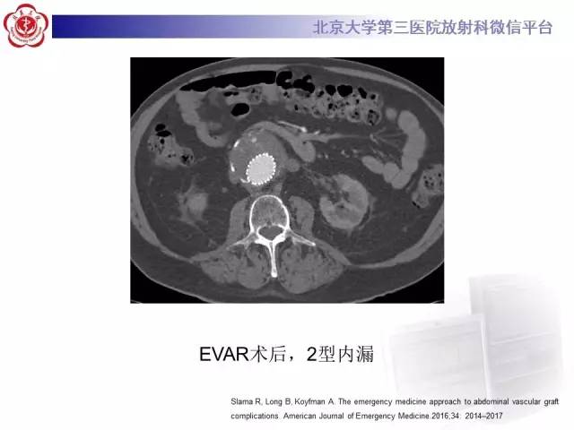 【病例】主动脉腔内修复术后并发症——内漏1例CT