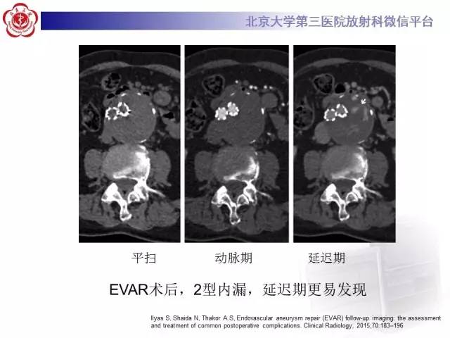 【病例】主动脉腔内修复术后并发症——内漏1例CT