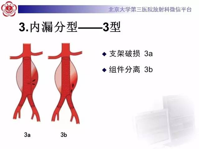 【病例】主动脉腔内修复术后并发症——内漏1例CT