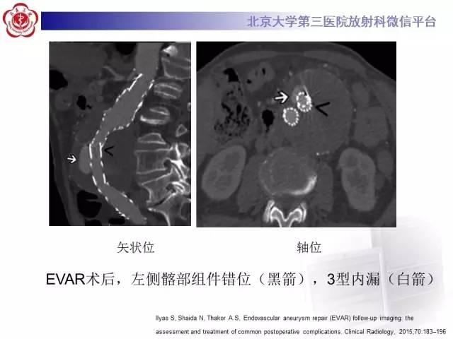 【病例】主动脉腔内修复术后并发症——内漏1例CT