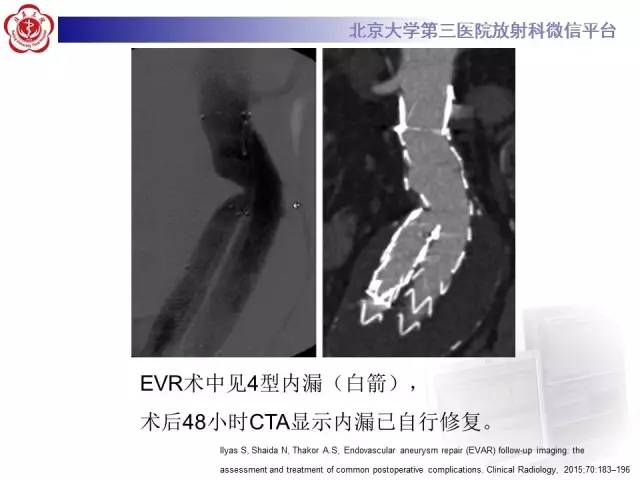 【病例】主动脉腔内修复术后并发症——内漏1例CT