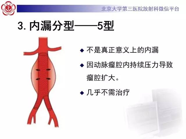 【病例】主动脉腔内修复术后并发症——内漏1例CT