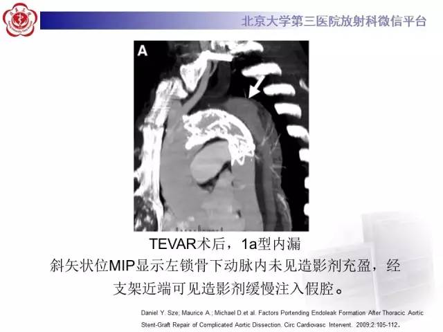 【病例】主动脉腔内修复术后并发症——内漏1例CT