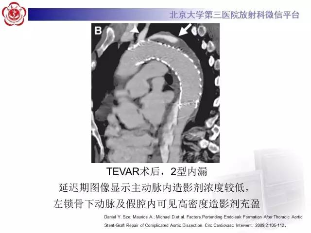 【病例】主动脉腔内修复术后并发症——内漏1例CT