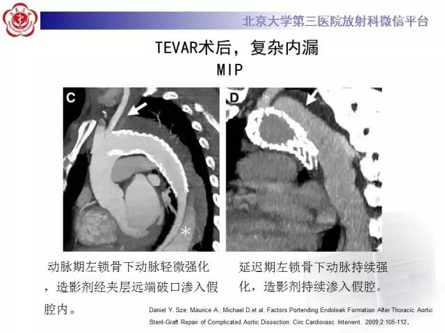 【病例】主动脉腔内修复术后并发症——内漏1例CT