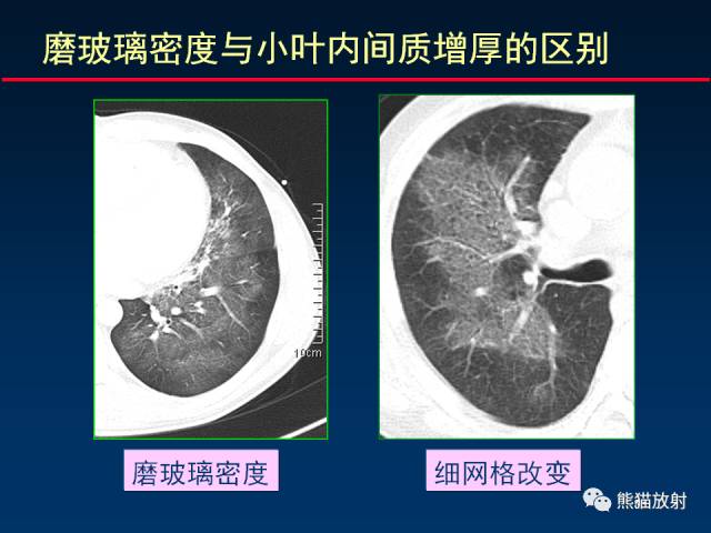 【PPT】影像诊断流程质量控制的重点在哪里？——从CT报告谈起