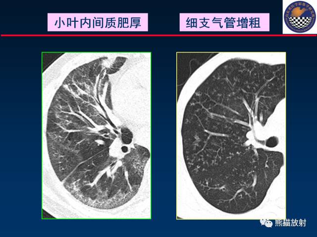 【PPT】影像诊断流程质量控制的重点在哪里？——从CT报告谈起