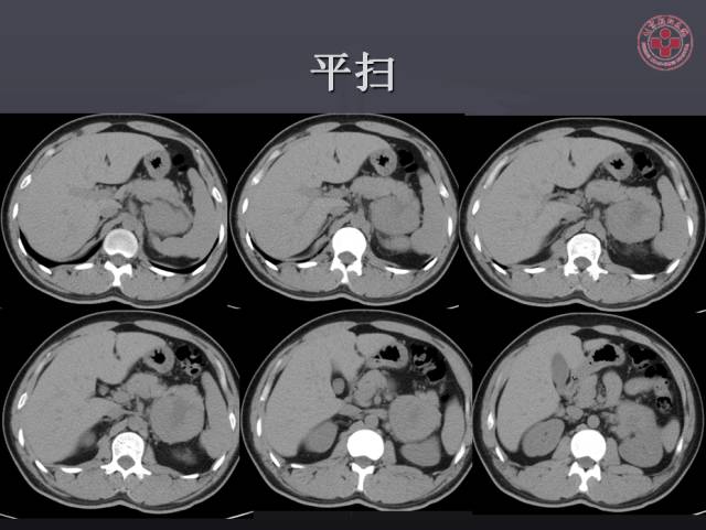 【病例】左侧肾上腺嗜铬细胞瘤1例CT