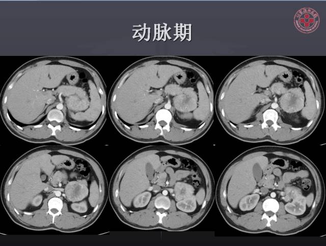 【病例】左侧肾上腺嗜铬细胞瘤1例CT