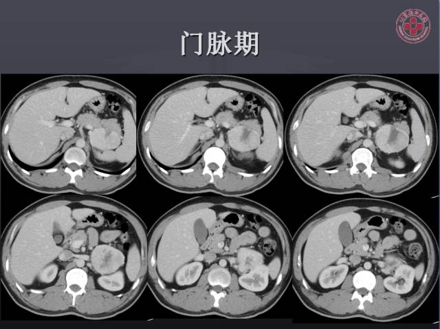 【病例】左侧肾上腺嗜铬细胞瘤1例CT