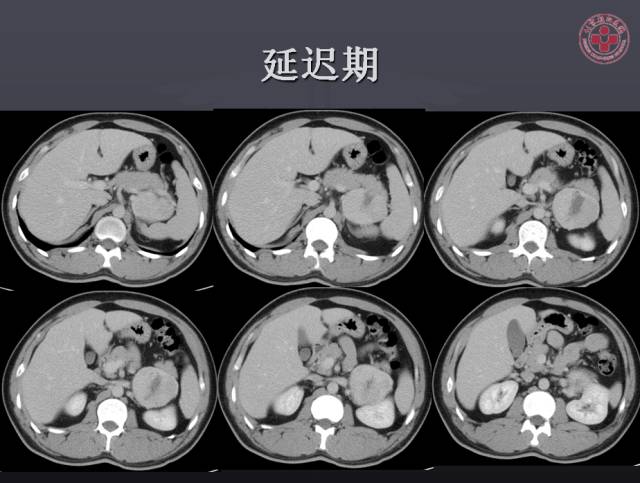 【病例】左侧肾上腺嗜铬细胞瘤1例CT