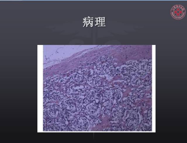 【病例】左侧肾上腺嗜铬细胞瘤1例CT