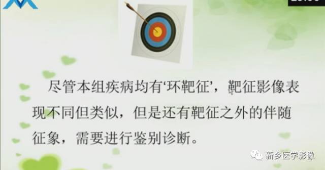 【PPT】颅内“靶征”疾病的影像诊断与鉴别
