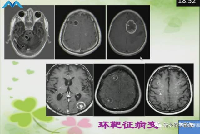 【PPT】颅内“靶征”疾病的影像诊断与鉴别