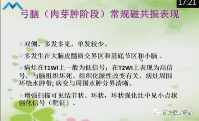 【PPT】颅内“靶征”疾病的影像诊断与鉴别